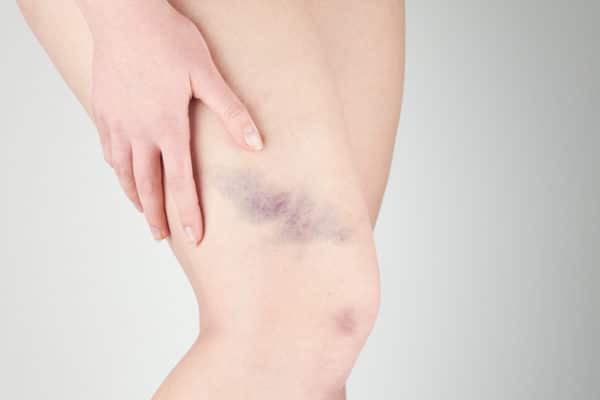 woman holding a bruised leg